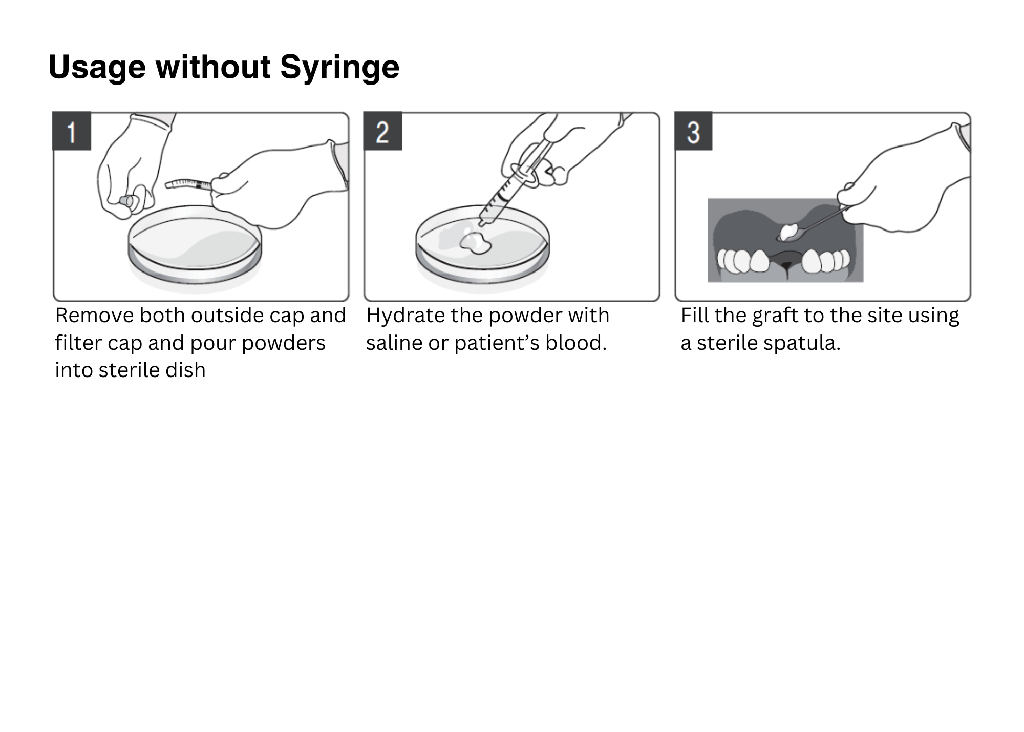 OsseoSeal Prefilled Bone in Syringe